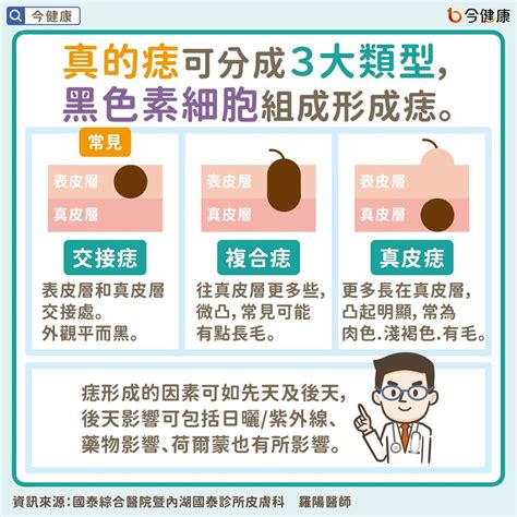 頭頂有黑痣|是痣or皮膚癌？醫「1張圖秒對照」 長這2部位最危險